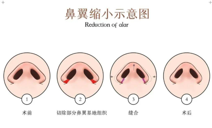 二、刘超整形医生缩鼻翼鼻头多少钱？2026年真实价格体系拆解