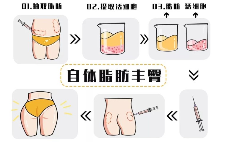 三、黄旭培臀下脂肪瓣包裹手术价格大揭秘:3万到6万,花得值不值?对比5家医院给你看