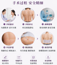 一、杭州抽脂医生刘文鑫技术口碑与真实评价深度解析