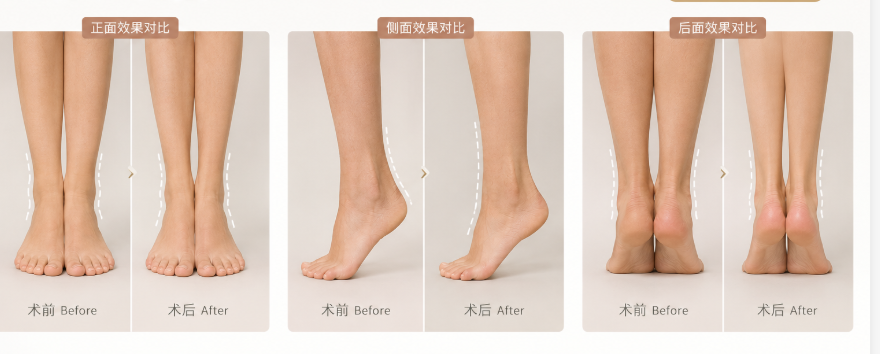 宁波吸脂医院哪家强?宁波艺星、宁波珈禾、宁波韩美都是当地实力机构