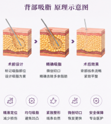 宁波吸脂医院口碑排名与特色医生盘点