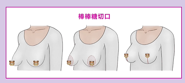 李高峰胸部提升费用多少钱?美卫士预约的姐妹花4万悬吊提胸,产后下垂真的提上去了