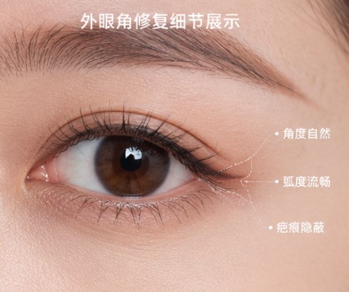 杭州黄良飞眼修复怎么样?擅长处理高难度眼修复,比如肉条、疤痕、不对称等问题
