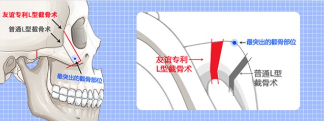 磨骨术后关键期护理指南