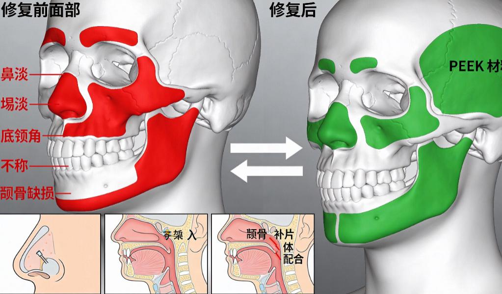上海时光何晋龙PEEK下巴修复实例亲测分享,效果自然不踩雷,10万+真实病例可验证
