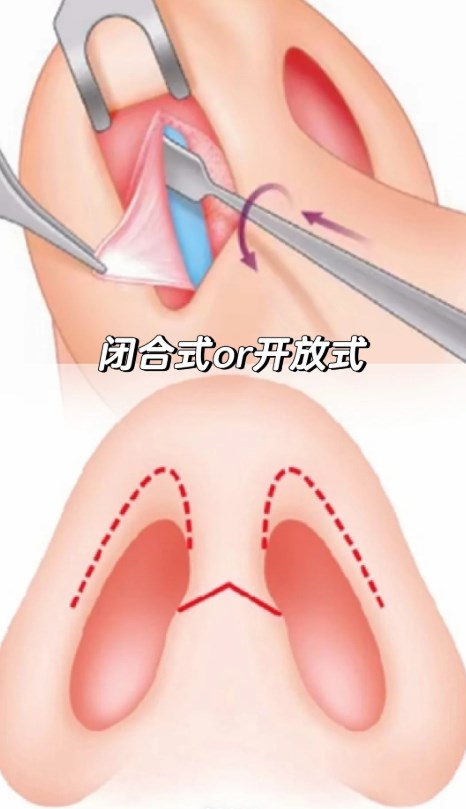 太原安美聚光媛怡医疗美容隆鼻多少钱,隆鼻价格大概1.5万元起技术很棒