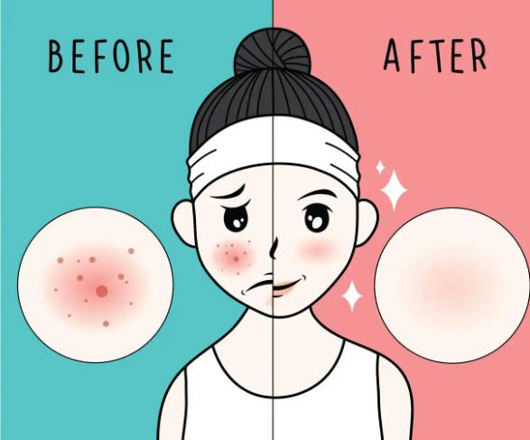 二、在运城华美找史睿凡做光子嫩肤,不同需求的价格参考