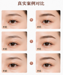 三、想了解提眉的实在成效?头一手评价比广告靠谱一万倍