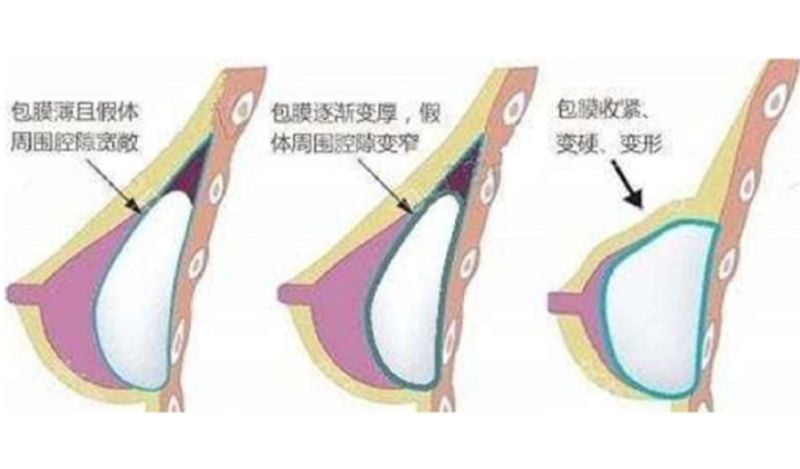 二、万友望隆胸医生预约难吗?先了解技术再决定也不迟