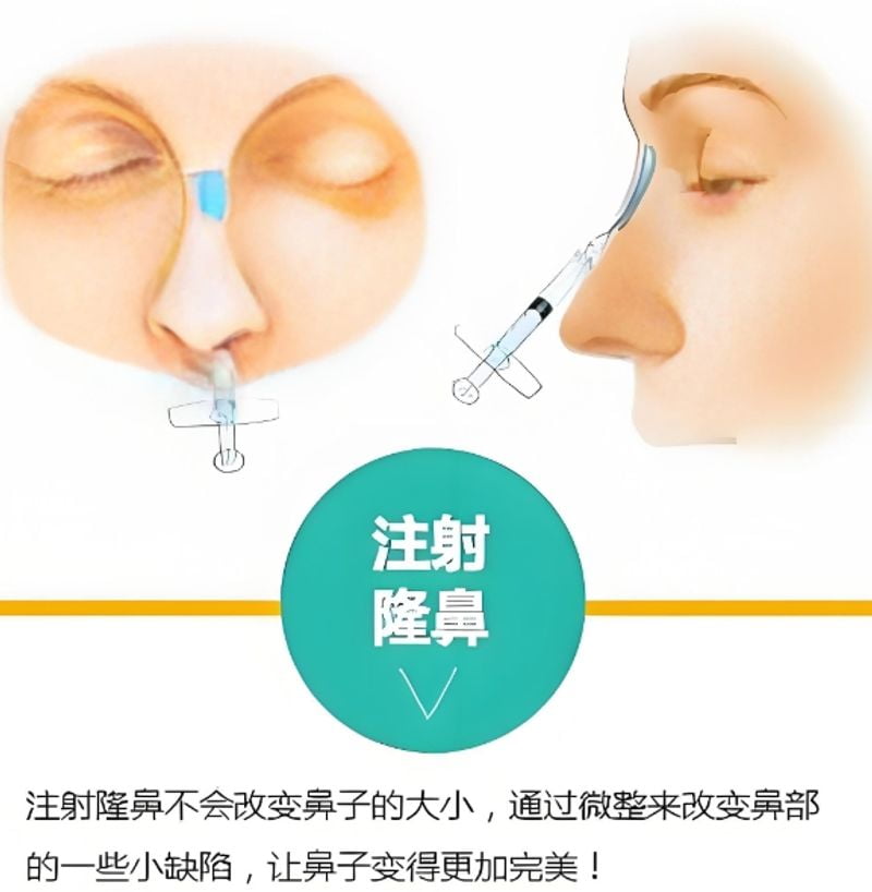 三、温州和平梁赞姜医生隆鼻价格贵不贵?不同鼻子基础怎么选?
