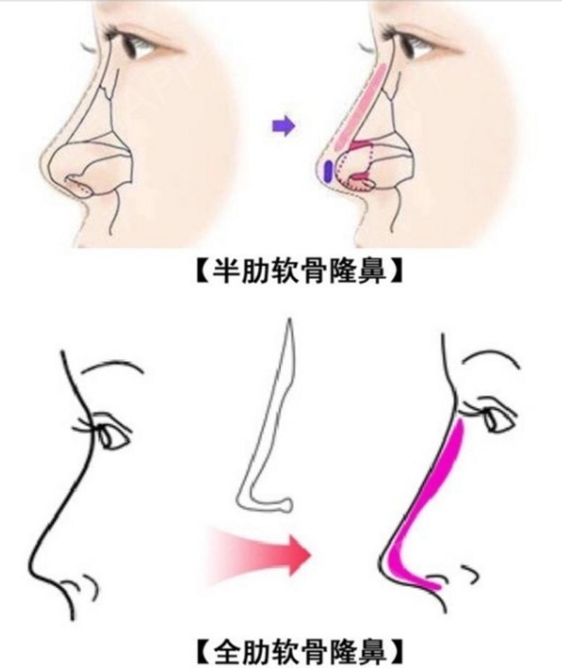 杨万忠隆鼻价格表:含肋软骨取材一般2.5w起,修复鼻另算视破坏程度定
