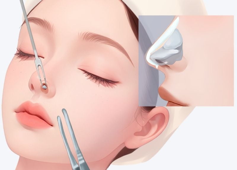 五、关于李超仁隆鼻的常见问题解答(FAQ)
