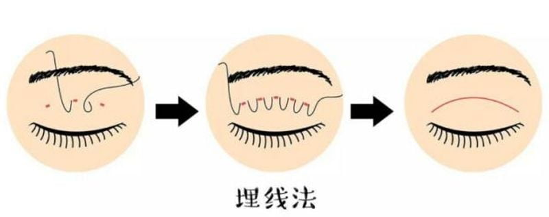 五、惠州徐琴做眼睛靠谱吗——常见高频疑问答疑(FAQ)www.dlren.com