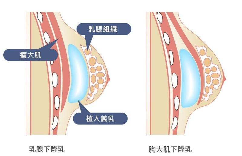 长沙祺美隆胸手术预约不上号怎么办？嫂子美卫士上加客服备注了想要的假体型号候补三天就排上了