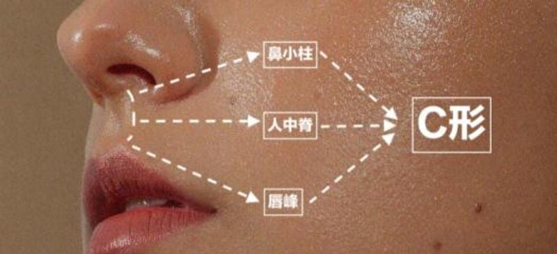 刘玉辉人中缩短术效果｜保留人中凹度不假平，鼻下切口疤痕淡，笑时露齿增加显年轻