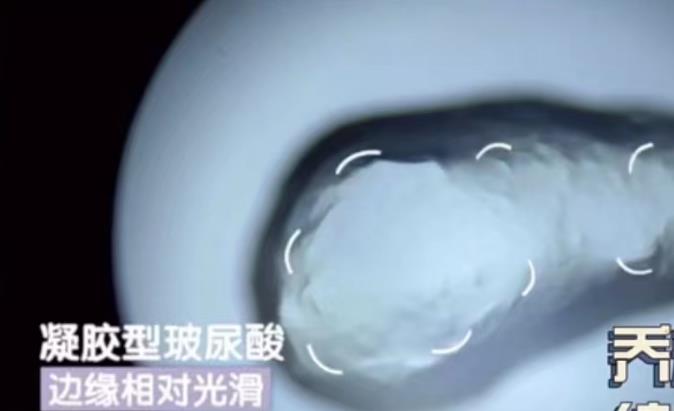 阿克苏医美整形打玻尿酸机构深度解析