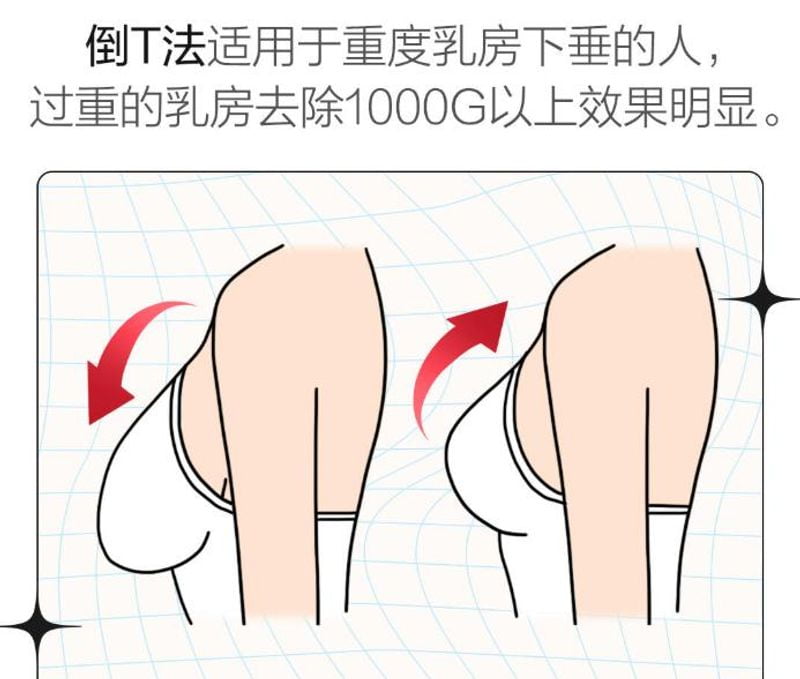 栗勇缩胸手术国内认可吗？超多姐妹亲测认可，垂直切口疤痕超隐蔽，术后胸型自然漂亮