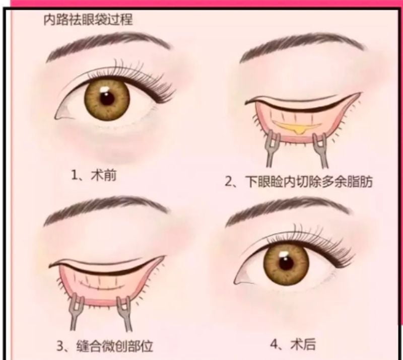 四、避坑指南:选毕珍医生做眼周抗衰,哪些人适合?哪些坑要绕开?