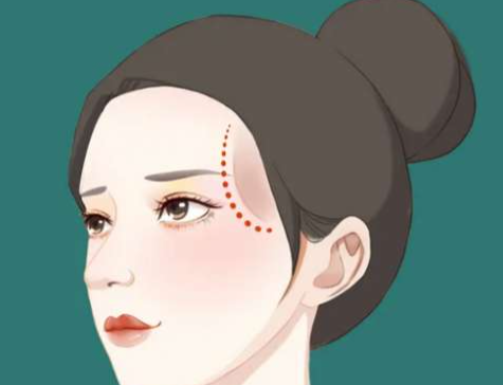 三、太阳穴填充多少钱一次?算清“长期账”才不花冤枉钱