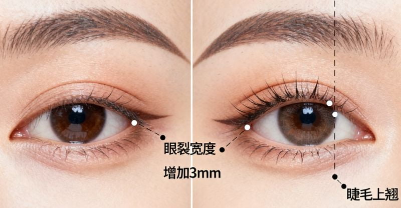 微创双眼皮最低多少钱?县城做埋线2980元起能信吗