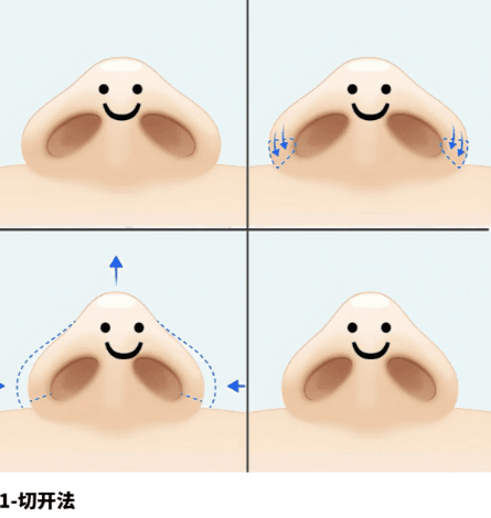 如何根据自身需求选择洛阳隆鼻医院?