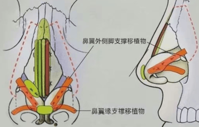 五、和其他方案比,杨晓松爱贝芙宽鼻翼到底值不值?