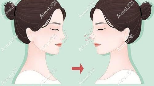 易普锋医生做过的鼻子实例分享www.dlren.com 易普锋医生做过的鼻子实例分享www.dlren.com