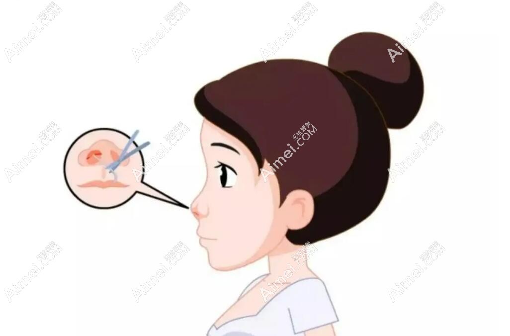 易普锋做鼻子多少钱?1-3万元起很低 易普锋做鼻子多少钱?1-3万元起很低
