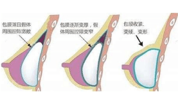 二、长沙祺美取硅胶胸部假体技术怎么样,找肖征刚院长修复口碑好像不错?三位院长怎么选
