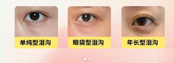 二、打胶原蛋白填泪沟比打玻尿酸好在哪里?