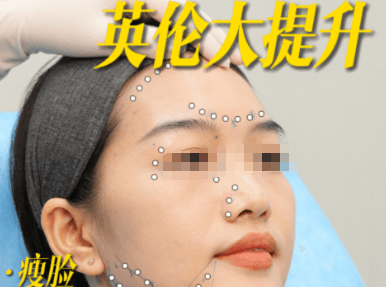 三、天津赫泰佳颜医疗美容英伦大提升适用人群与术前考量:你适合做吗?www.dlren.com