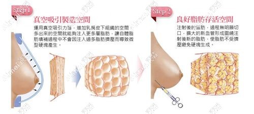 孙泽芳脂肪填充丰胸成活率多少 孙泽芳脂肪填充丰胸成活率多少