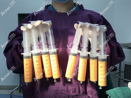 孙泽芳自体脂肪丰胸价格多少 孙泽芳自体脂肪丰胸价格多少