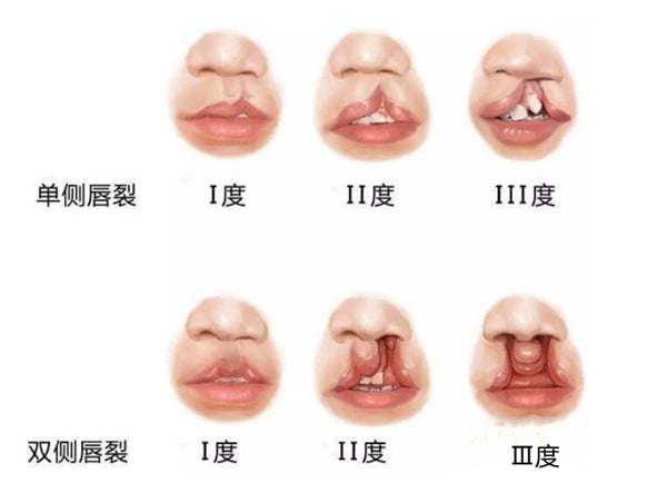 余文林双侧唇裂修复做得好！对称度高疤痕隐蔽，真实效果确实靠谱！
