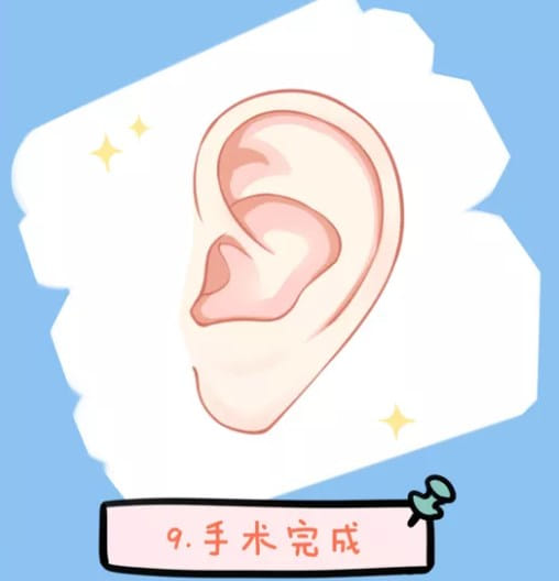 二、同样是张正文主刀,为什么有人住院3天,有人却要7天?