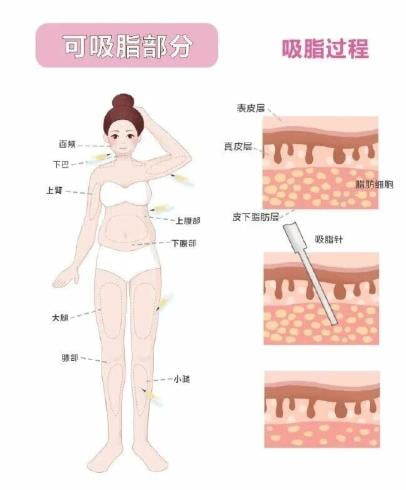 三、 如何可靠地迈向你的“折角腰”:术前必做功课www.dlren.com