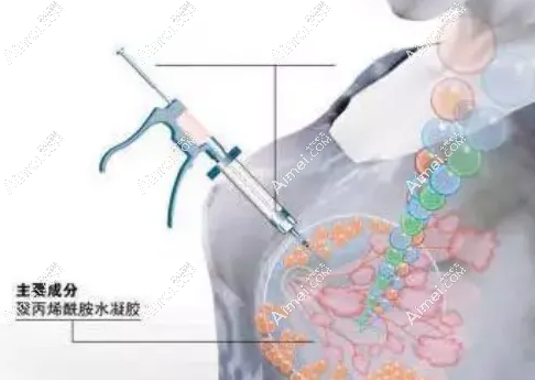 国内奥美定隆胸取出十大医院技术好 国内奥美定隆胸取出十大医院技术好