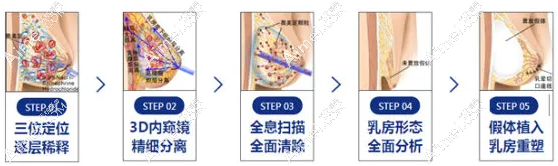 广州荔湾胸部奥美定清奥修复技术dlren.com 广州荔湾胸部奥美定清奥修复技术dlren.com