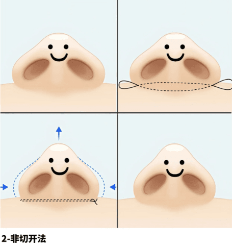 三、胡海洋隆鼻技术怎么样?术后恢复与功能保护