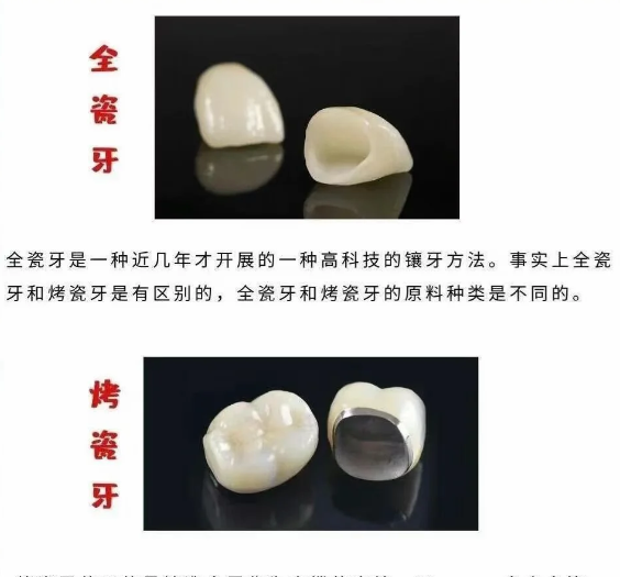 026 北京烤瓷牙价格汇总!钴铬、贵金属牙冠收费参考,上贝色比对多家口腔报价