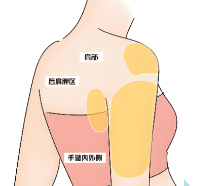 二、为什么手臂吸脂纯脂肪量超过500ml,常被建议结合塑形?www.dlren.com