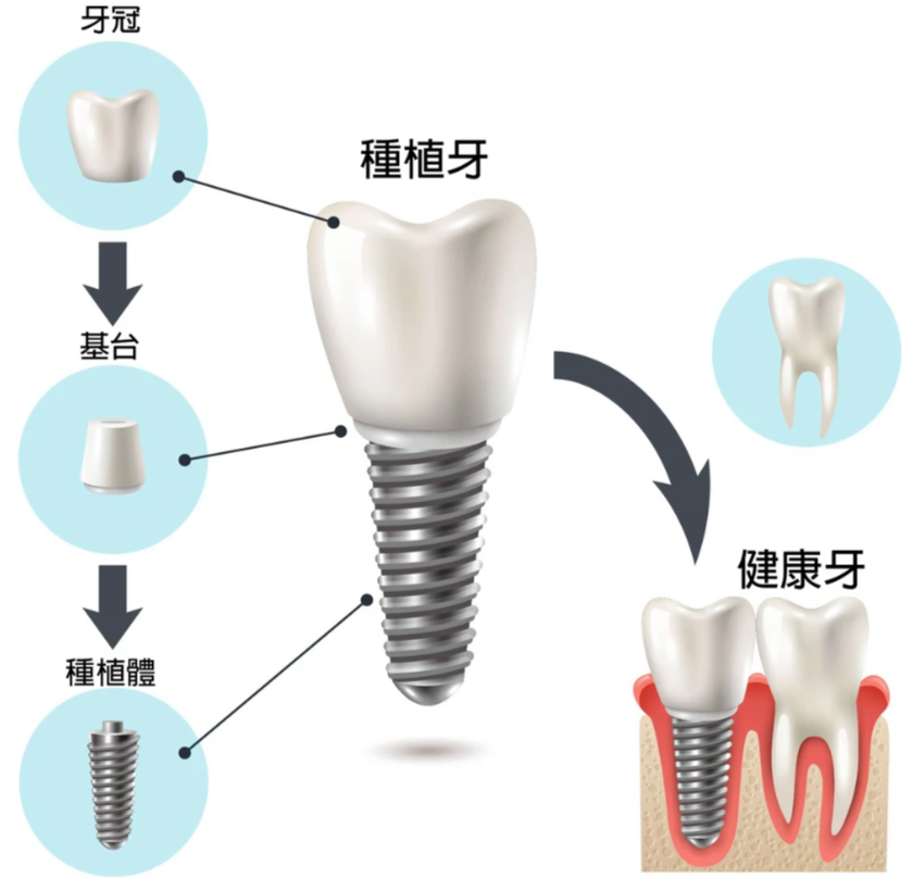 银川诺贝尔口腔种植牙价格一览:2026最新价目表及就诊全攻略(附贝色预约通道)