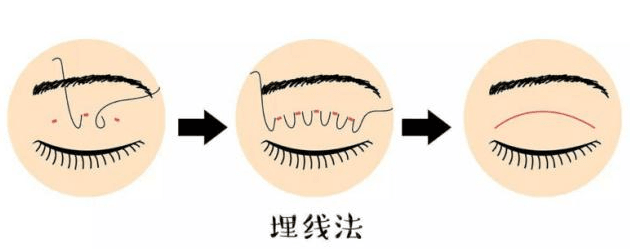 二、双眼皮修复手术:为什么在邵阳格莱美价格翻倍?