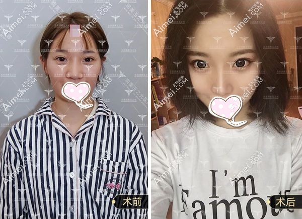张红芳博士面部自体脂肪填充案例图.jpg 张红芳博士面部自体脂肪填充案例图.jpg