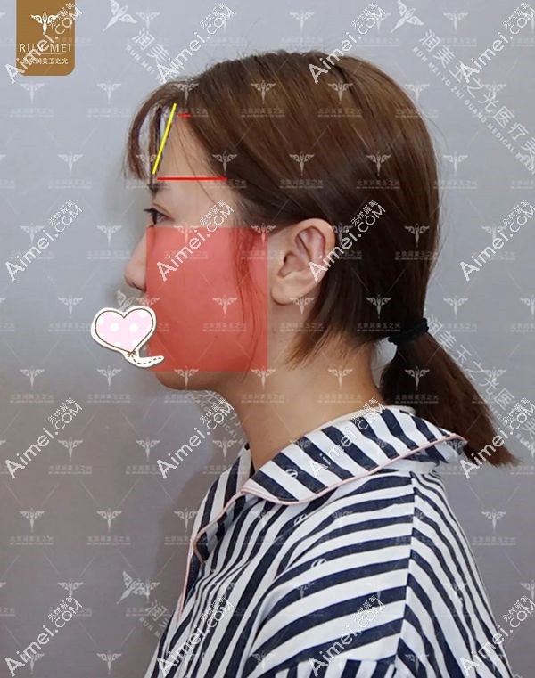 张红芳医生分析求美者术前90°侧脸填充脂肪情况.jpg 张红芳医生分析求美者术前90°侧脸填充脂肪情况.jpg