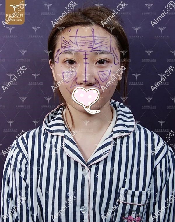 北京润美玉之光张红芳设计好自体脂肪填充的手术部位.jpg 北京润美玉之光张红芳设计好自体脂肪填充的手术部位.jpg