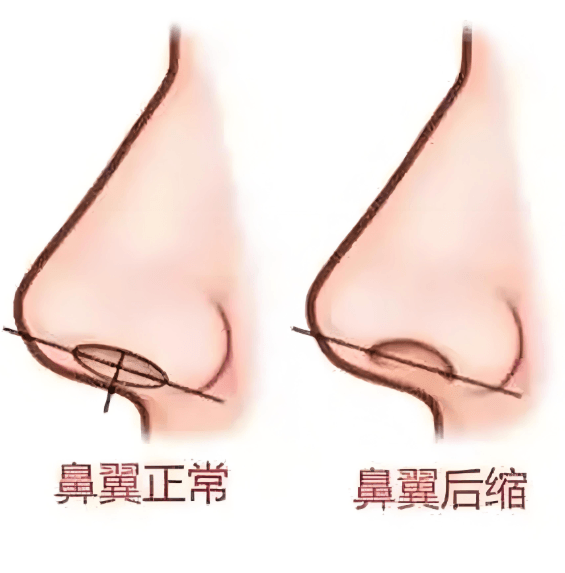 深圳鼻翼缩小价格参考:别被低价冲昏头www.dlren.com