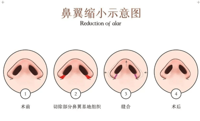 选鼻翼缩小医生,这几点必须看
