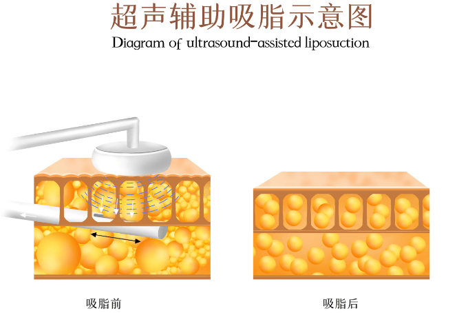 杭州丽脂超模体雕成效怎么样?(含实例说明)