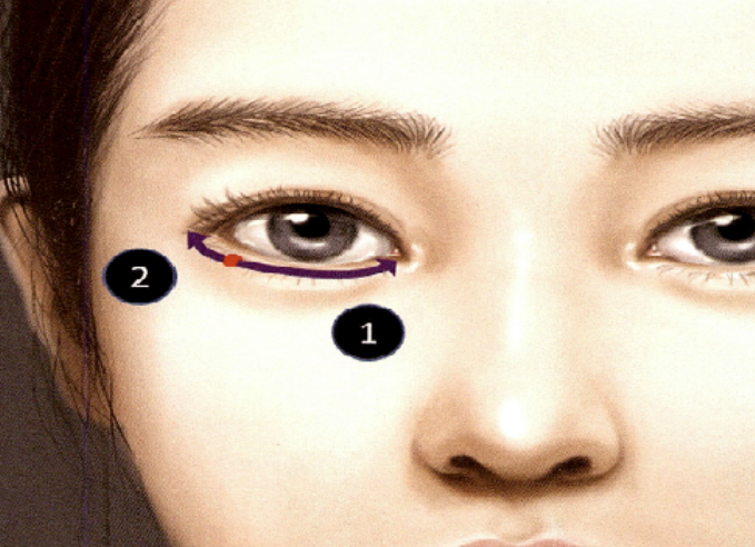 怕打成僵硬肉条?南宁彭正春打卧蚕靠谱吗?揭秘眼轮匝肌下注射,无痕打造幼态眼!